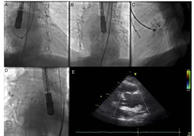 Figure 2 Images illustrating percutaneous closure of aortic pseudoaneurysm. (A) Left internal mammary diagnostic catheter inside the delivery sheath engaging the pseudoaneurysm cavity; (B) Amplatzer atrial septal defect (ASD) occluder with the distal disk 