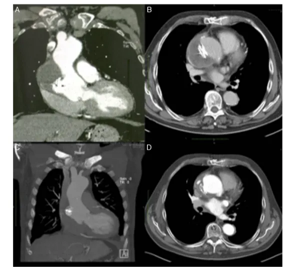 Figure 3 Evolution over time of ascending aortic pseudoaneurysm closure. (A and B) Computed tomography (CT) scan at one month showing Amplatzer ASD device in a stable position and organizing thrombus inside the pseudoaneurysm cavity; (C and D) CT scan at o