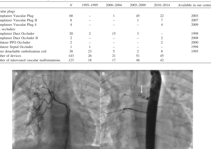 Fig. 1. A: Aortopulmonary collateral with 2 mm of diameter before intervention, (B) and after clo- clo-sure with a Flipper detachable embolization coil (arrow), with no residual flow through the device.
