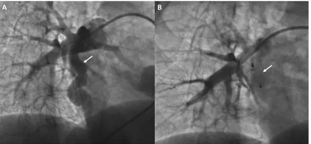 Fig. 3. A: Large pulmonary arteriovenous fistula with 13 mm of diameter before intervention (arrow), (B) and after closure with an Amplatzer Vascular Plug II (arrow), with no residual flow through the device.