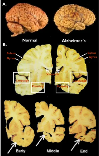 Figure  1.  Normal  versus  Alzheimer´s  brain.  A.  Brain  volume  reduction  and  atrophy  characteristic  of  AD  patients  (right)