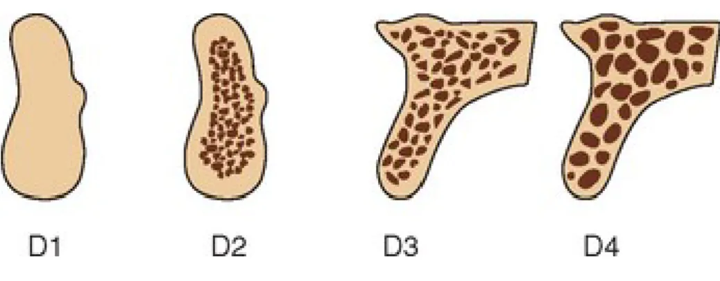 Figura 3 - Densidade óssea segundo a Classificação de Misch (1988). https://pocketdentistry.com/7-bone- https://pocketdentistry.com/7-bone-density-a-key-determinant-for-treatment-planning/  