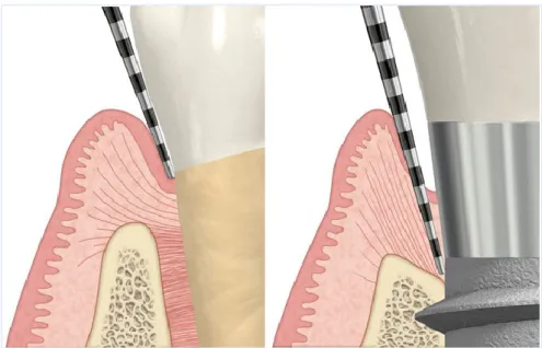 Figura 4 - Comparação da profundidade de sondagem no dente e no implante, ambos com mucosa saudável