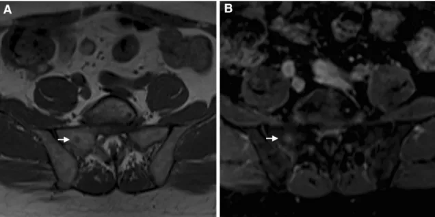 Fig. 11. Images in a 69-year-old man after RP. This patient had a PCa (GS 7). 6 years after surgery, BF was detected (PSA 1.90 ng/mL)