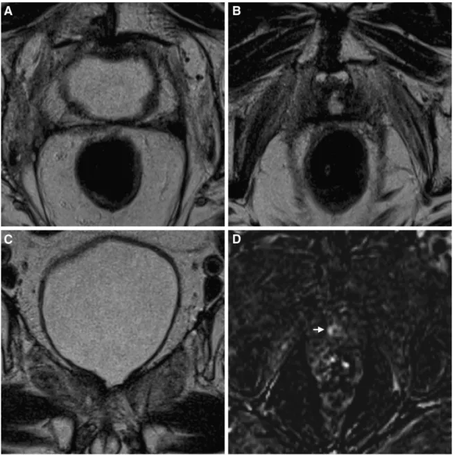Fig. 2. Axial (A, B) and coronal (C) T2WI show normal post- post-prostatectomy fibrosis at the level of seminal vesicles (A) and typical appearance of the bladder neck (B, C)