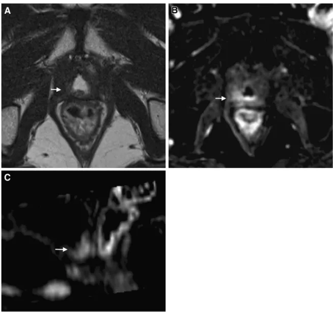 Fig. 5. Images in a 65-year-old man after RP. This patient had a PCa (GS 7 and initial PSA of 12.6 ng/mL)