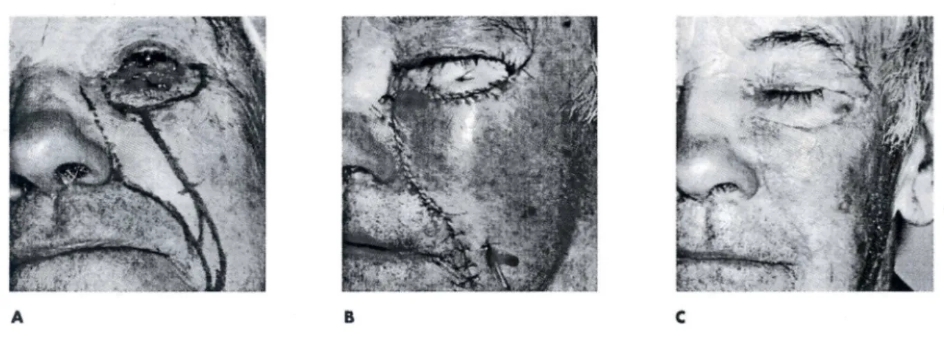 Figura A: esbo&lt;;o do retalho nasogeniano de pediculo superior e da exerese do tumor.
