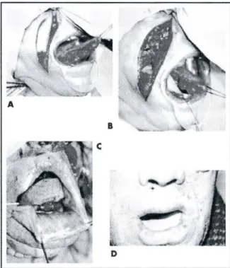 Figura B: Retalho com pediculo nos vasos labiais com circula&lt;;:ao arterial de f1uxo retrogrado da arteria labial contralateral.