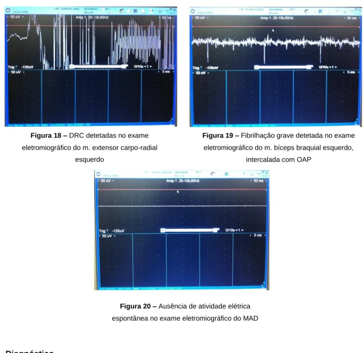 Figura 20 – Ausência de atividade elétrica  espontânea no exame eletromiográfico do MAD Figura 18 – DRC detetadas no exame 