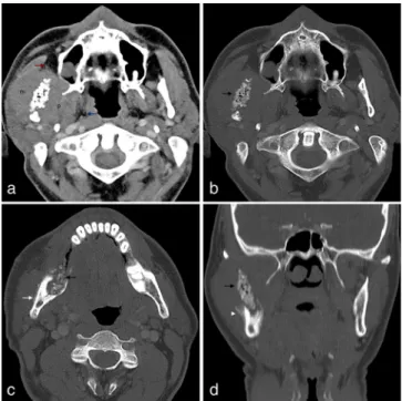 Figure 2. (a, b) Synchronized axial T 1 weighted and T 2 weighted MR images show multiple coalescent hypointense foci in the region of the mandibular ramus (white arrow) and a surrounding soft tissue component isointense and  hyperin-tense in relation to t