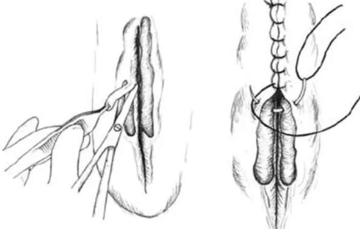 Figura 4: Representação da colocação da sutura de Caslick (Peter, 2015) 