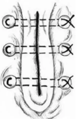 Figura 9: Representação da colocação da sutura de colchoeiro vertical com stents  (Adaptado de Peter, 2015) 