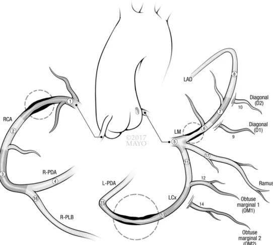 Fig. 2    Coronary artery tree,  17 segment model. In a case  of a 45-year-old who has  plaque in 3 of 17 segments  (circled), SIS would be 3 and  aSIS 0.39