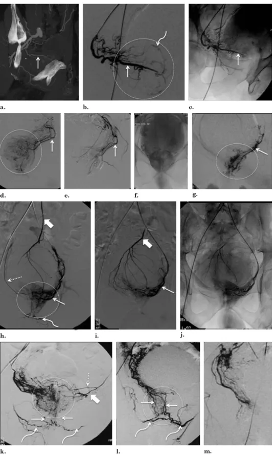 Figure 10. DSA findings of PAs and arterial anastomoses. (a) Sagittal MIP CT angiography shows a right-side PA (straight arrow)