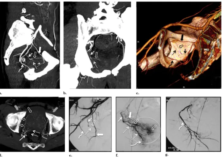 Figure 3. Images from a case with a solitary PA. (a) Pelvic CT angiography with sagittal MIP reformat shows a solitary PA (straight arrow) arising from the internal pudendal artery (curved arrow) above the sciatic notch on the right pelvic side