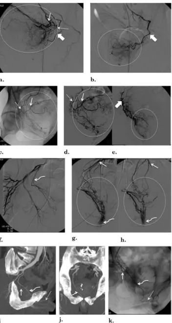 Figure 8. Illustrations of a potential pitfall of PAE, namely, neighboring arteries that may be confused with PAs: (a– e)  ves-ical arteries and PAs, (f– h) rectal arteries, and (i– k) accessory pudendal arteries