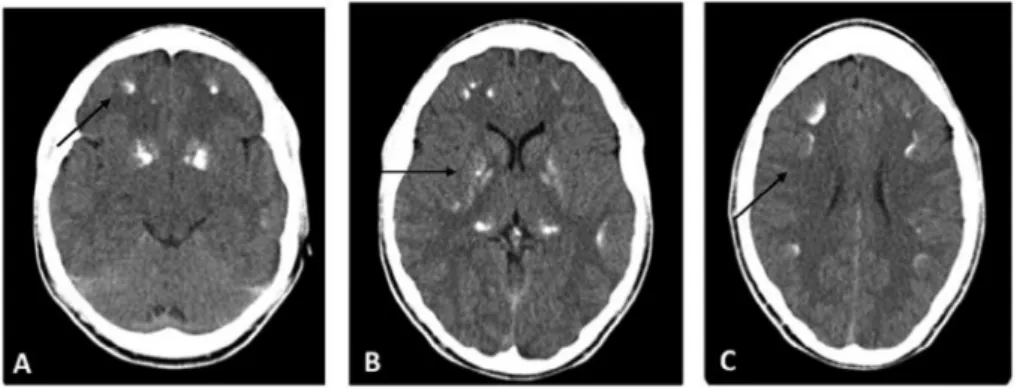 Figure 1. head ct demonstrating (a) multiple subcortical calcifications in frontal area, (B) basal ganglia and (c) in fronto-parietal  areas.