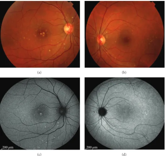 Figure 1: Retinography evidenced multiple, small, round, yellow-white lesions limited to the posterior pole of both eyes, with greater macular involvement in the RE.