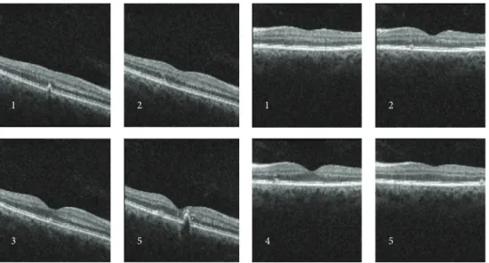 Figure 4: Optical coherence tomography showed the presence of focal elevations of the RPE with underlying hyporeflective space, bilaterally.