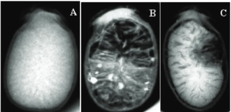 Figure 1. X-ray images of  Xylopia aromatica seeds which  are  undamaged  (A)  and  damaged,  with  no  internal fi lling (B) and with abnormalities (C).