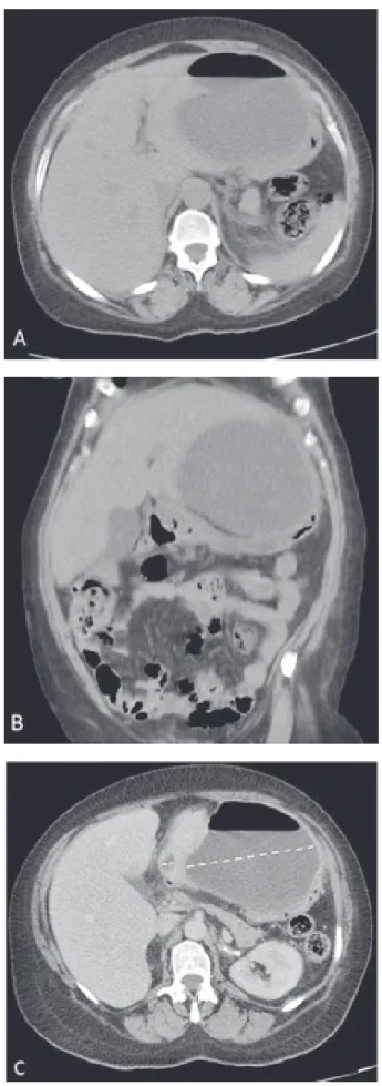 Figure 1: Initial abdominal CT: (A) Axial image and (B) Frontal  image showing the larger abscess in the left hepatic lobe with an  air-fluid level
