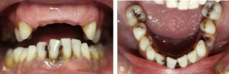 Figure 3: (A) Frontal intraoral photograph with decayed teeth  and signs of periodontitis and (B) Occlusal intraoral photograph  of the jaw showing both decayed molars and a residual root of  the left mandibular first premolar.