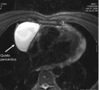 Figura  2.    Ressonância  magnética  cardíaca,  mostrando  derrame  pericárdico,  com  volumoso  quisto  pericárdico  preenchido.