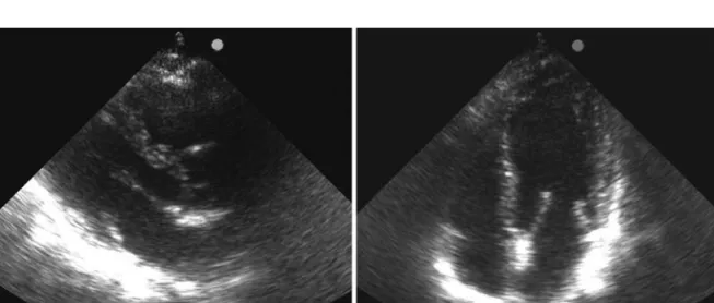 Figure  4.  Pericardial  effusion  three  months  after  pericardial  drainage  (A:  left  parasternal  long-axis  view;  B:  left  parasternal short-axis view; C: 4-chamber apical view).
