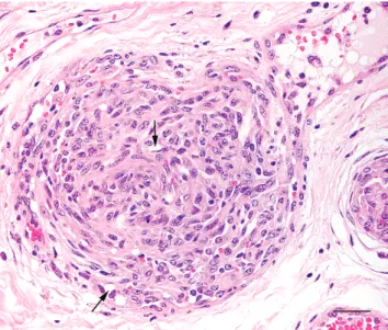 Figure 1. Epithelioid hemangiosarcoma; urinary bladder;