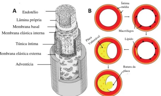 Figura 1.2 - (A) Diagrama típico de uma parede da artéria com as suas camadas e  tecidos, (B) Diagrama esquemático ilustrativo do progresso da aterosclerose numa 