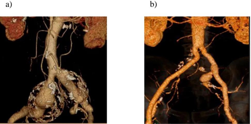 Figura 6 – a) Aneurisma da artéria ilíaca comum 5  e b) Aneurisma da artéria  ilíaca interna 6 , obtidas através de exames angiotomográficos