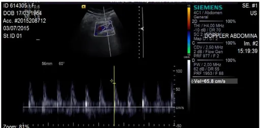 Figura 7 – Imagem de ultrassonografia Doppler espectral da AAA, adquirida com  equipamento Acusom S2000 da Siemens, retirada de Oliveira, (2015)