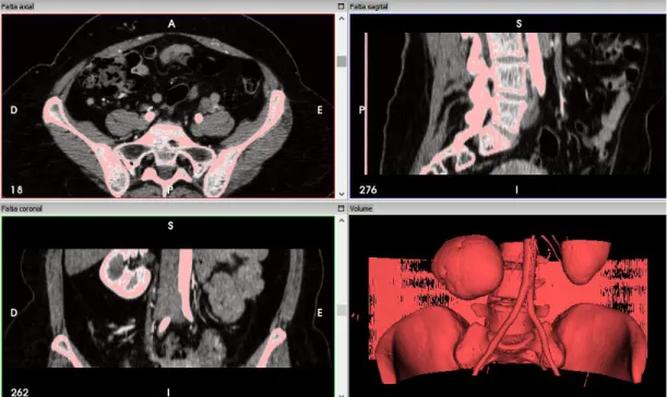 Figura 10 – Reconstrução semiautomática da artéria em diferentes perspetivas utilizando o software  InVesalius