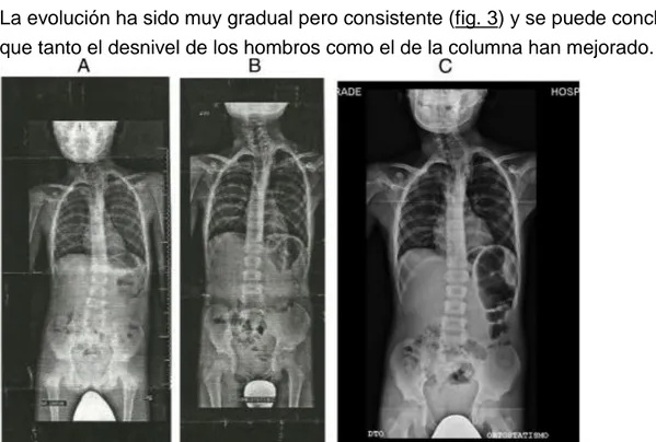 Figura 3. Imágenes radiológicas del paciente L.A. de 2014 (A), 2015 (B) y 2017  (C). 
