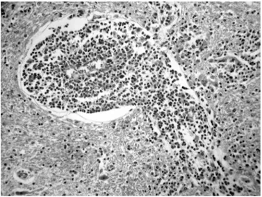 Fig. 2. Meningoencefalite granulomatosa associada ao pastoreio de ervilhaca. Mesencéfalo (Bovino 5)