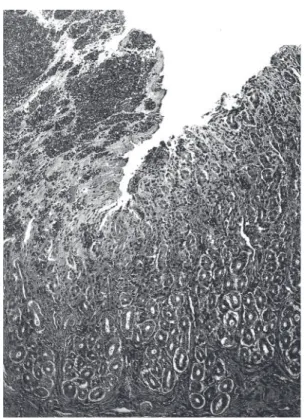 Fig. 11. Necrose, congestão e hemorragia no epitélio do abomaso, na intoxicação experimental pelas favas de S