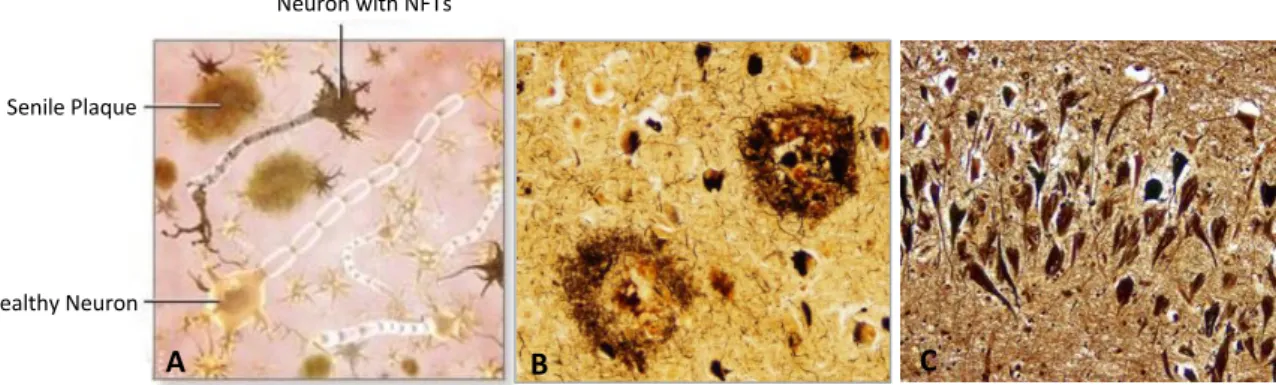 Figure 1 – Neuropathological Hallmarks of AD. A - Schematic representation of the neuropathological hallmarks  of AD