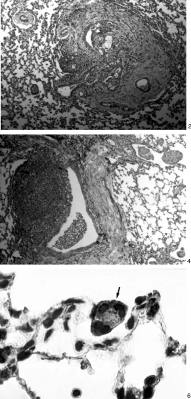 Fig. 1. Infecção natural pelo Vírus Sincicial Respiratório Bovino (BRSV). Presença de células sinciciais dentro de alvéolos