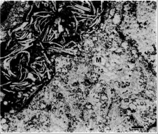 Fig. 7. Microfotografia eletrônica de linfonodo hepático.  Macrófa-go necrótico no canto  superi-or esquerdo, com numerosas imagens negativas de cristais aciculares no citoplasma