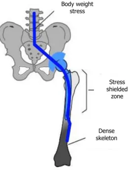 Figure 6 - Scheme of stress shielding after hip implant. After the implant insertion the body load is  carried by both the bone and the implant, resulting in reduced stresses on the bone (represented  in white), and consequent stress shielding