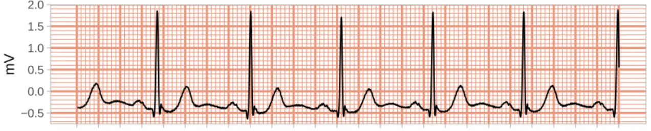 Figure 4.2: Segment of the record 103 from the MIT-BIH Arrhythmia Database