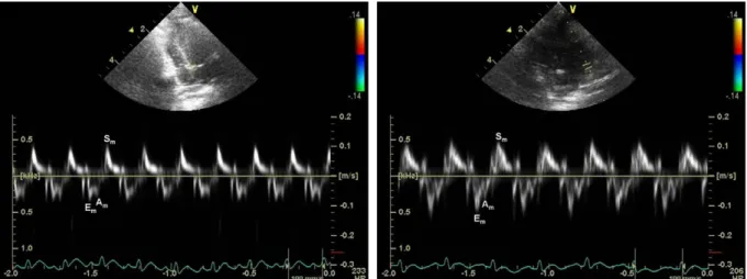 Fig. 1. The velocity proﬁles (E m , A m , S m ) obtained from pulsed tissue Doppler imaging of septal (left) and lateral (right) mitral annulus in rabbits