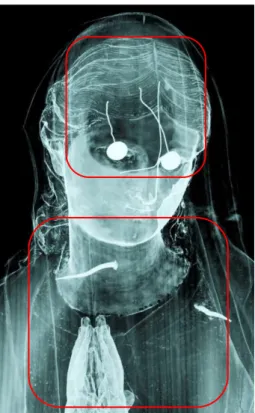 Figura  72  –  Na  radiografia,  é  notável  a  sombra  formada  pelo  oco  no  tórax  da  imagem  e  na  cabeça