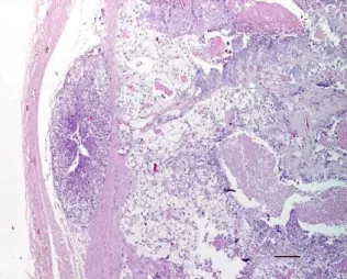 Figura 6 - Adenocarcinoma do endométrio  de gata, células claras. Estalão 500 µm. 