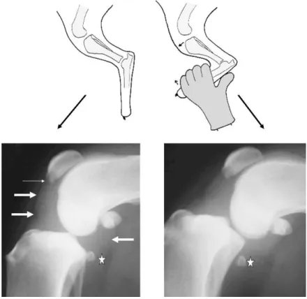 Figura  17:  Posicionamento  para  radiografia  neutra  e  radiografia  de  stress.  Radiografia  neutra  (à  esquerda): presença de osteófitos (→), efusão articular ()