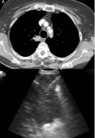 Figure 2 82-year-old patient with a solid lung lesion in the right upper lobe (a). The lesion was assessed by EUS-B-NA (b).