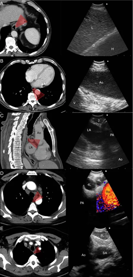 Figure 4 CT view and EUS-B view of the main anatomic landmarks (Ao --- aorta, D --- diaphragm, H --- heart, L --- liver, LA --- left atrium, Lu --- lung, PA --- pulmonary artery, SA --- subclavian artery, V --- vertebra).