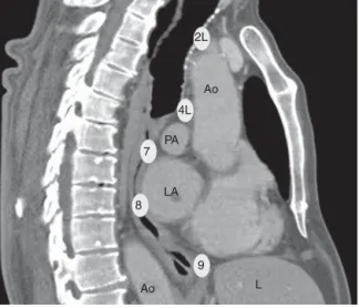 Figure 5 Sagital view of thorax CT with main acessible EUS-B lymph node stations (Ao  aorta, PA  pulmonary artery, LA  ---left atrium, L --- liver).