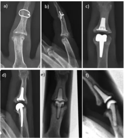 Figura 49 - Radiografias (anteroposterior e lateral) de 3 tipos de impalntes diferentes: A,B - Espaçador de Silicone; 