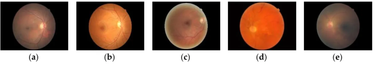Figure  1.  Random  samples  of  different  grades  of  diabetic  retinopathy.  (a)  grade  0,  (b)  grade  1,  (c)  grade 2, (d) grade 3, and (e) grade 4